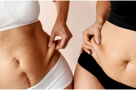 KAKO SE REŠITI MASNIH NASLAGA